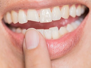 woman pointing to chipped tooth