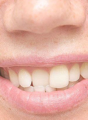 Woman having her teeth polished