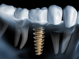 dark illustration of implant