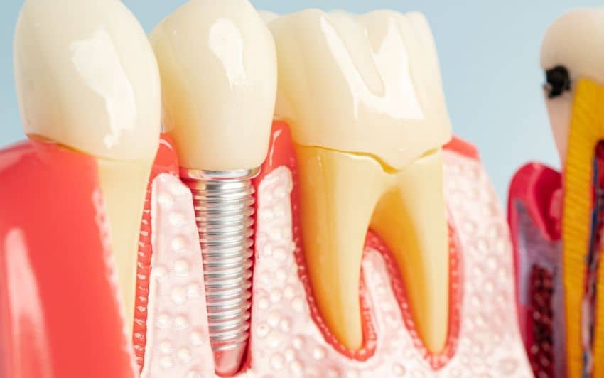 Replacing Teeth With Dental Implant