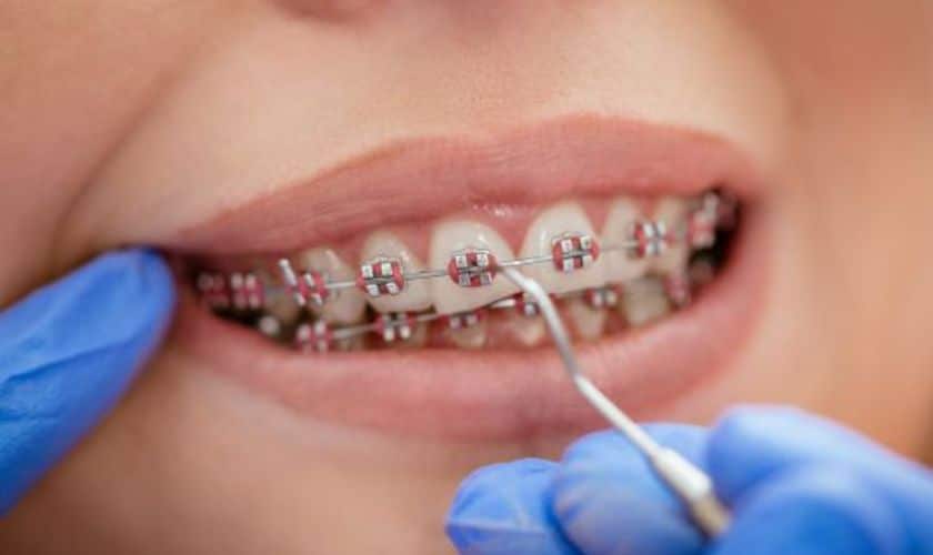What are the types of braces?