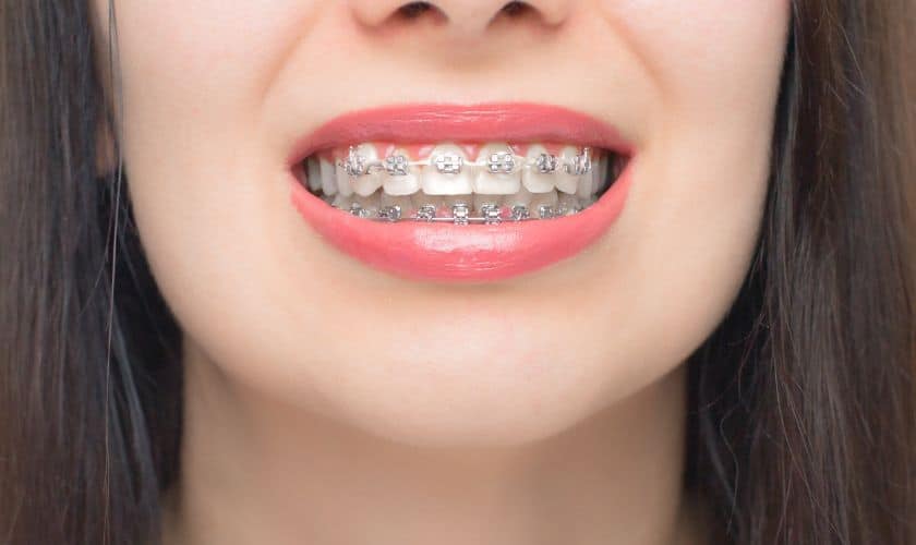 Smile Transformers: Embrace the Power of Braces in Rowlett