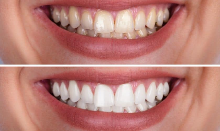 Teeth Whitening in Rowlett