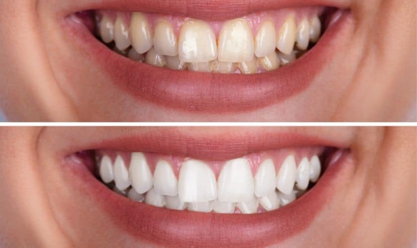 Whiter Teeth, Brighter Days: Embrace the Power of Teeth Whitening