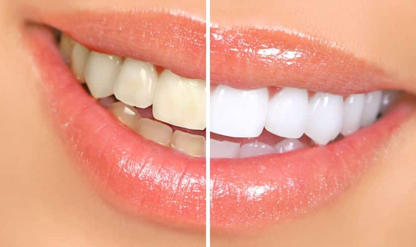 The Hidden Risks: Side Effects of DIY Teeth Whitening