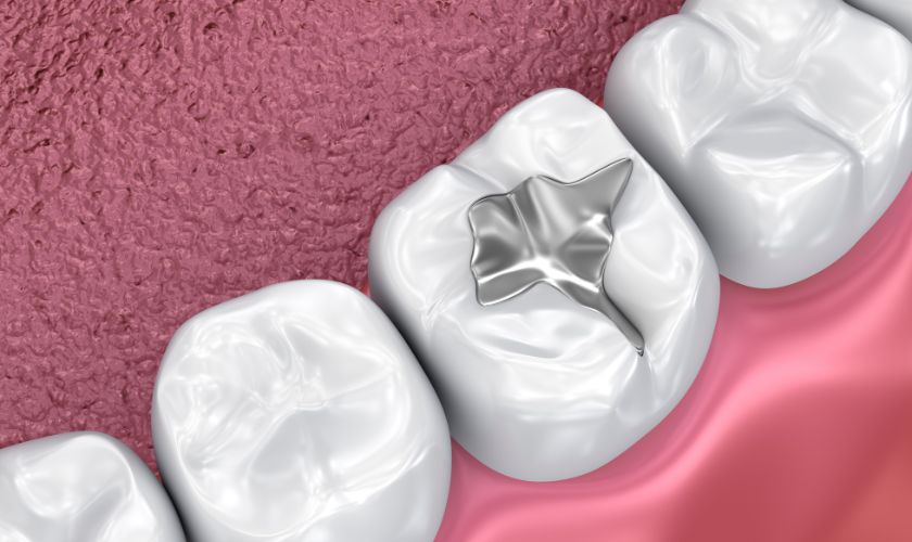 Choosing the Right Dental Filling Material: A Dentist’s Guide