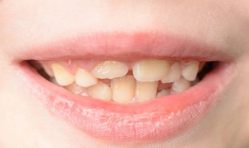 When Should You Go for Orthodontic Treatment?