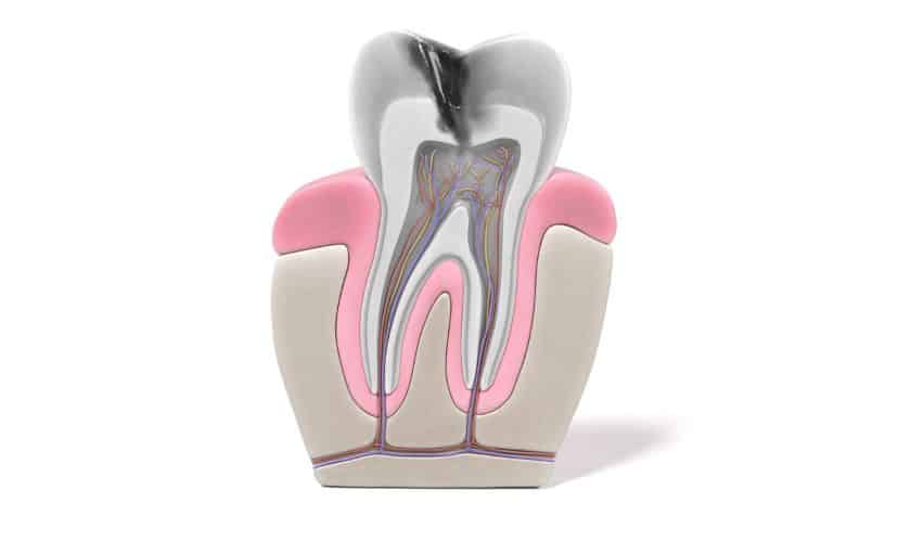 why root canal is done