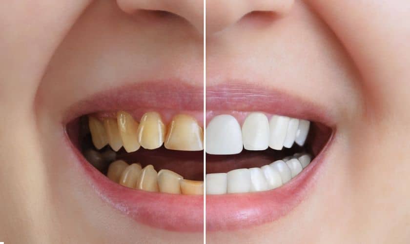 How Teeth Whitening Works on Your Pearly Whites