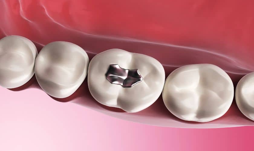 Different Types of Dental Fillings Available