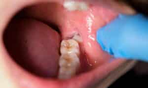 Eruption of Wisdom tooth
