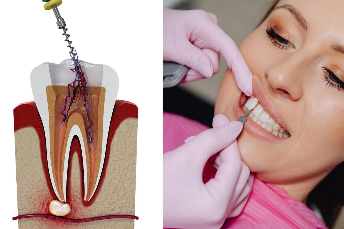 Root Canal Therapy vs. Tooth Extraction: Which Is the Better Option?