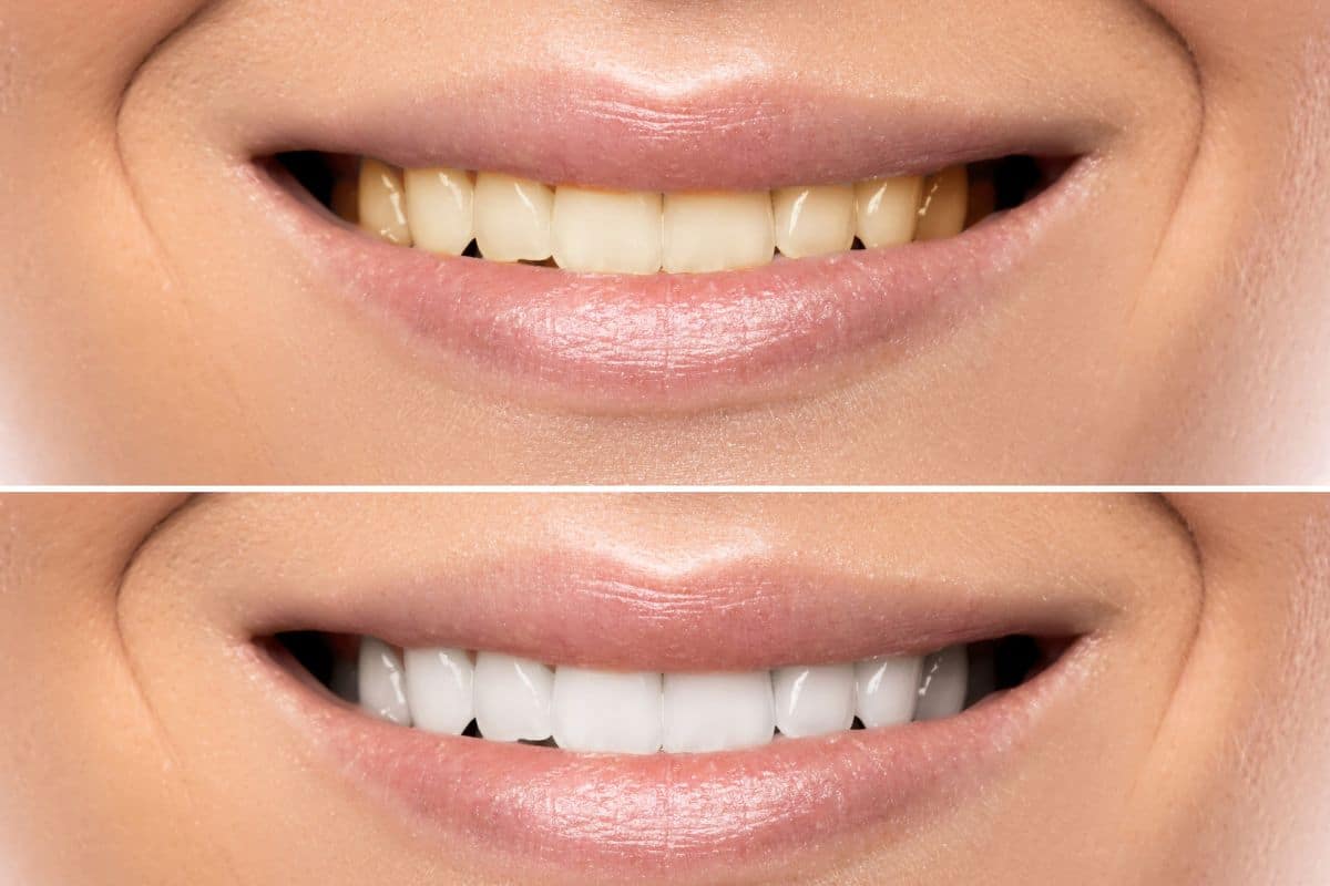 Maintaining Your Bright Smile: Tips After Teeth Whitening