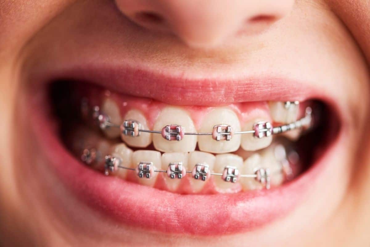 Best Oral Hygiene Practices for a Healthy Smile Post-Braces
