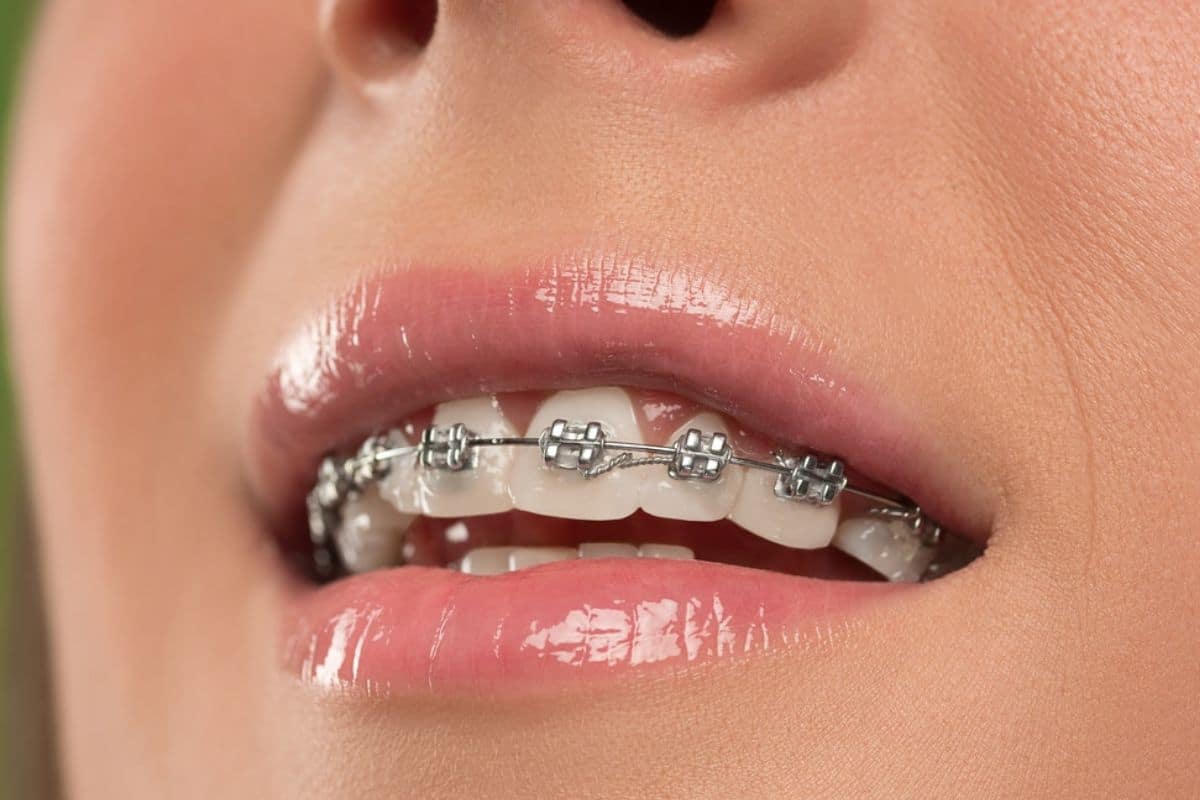 How to Take Care of Your Teeth After Braces Treatment?