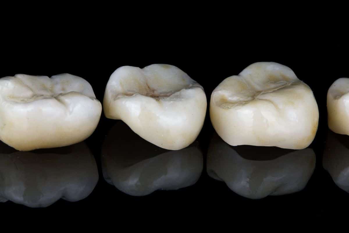 How to Know When You Need a Dental Crown?