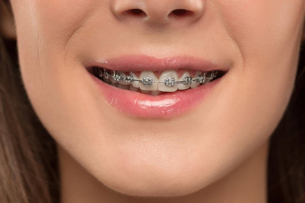 What Should You Do If Your Braces Break?