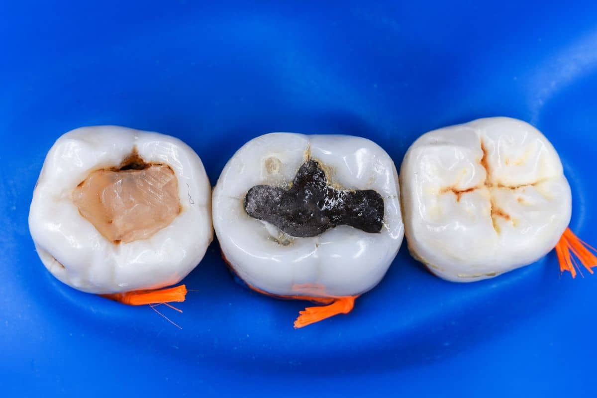 How Long Do Tooth Colour Fillings Last?