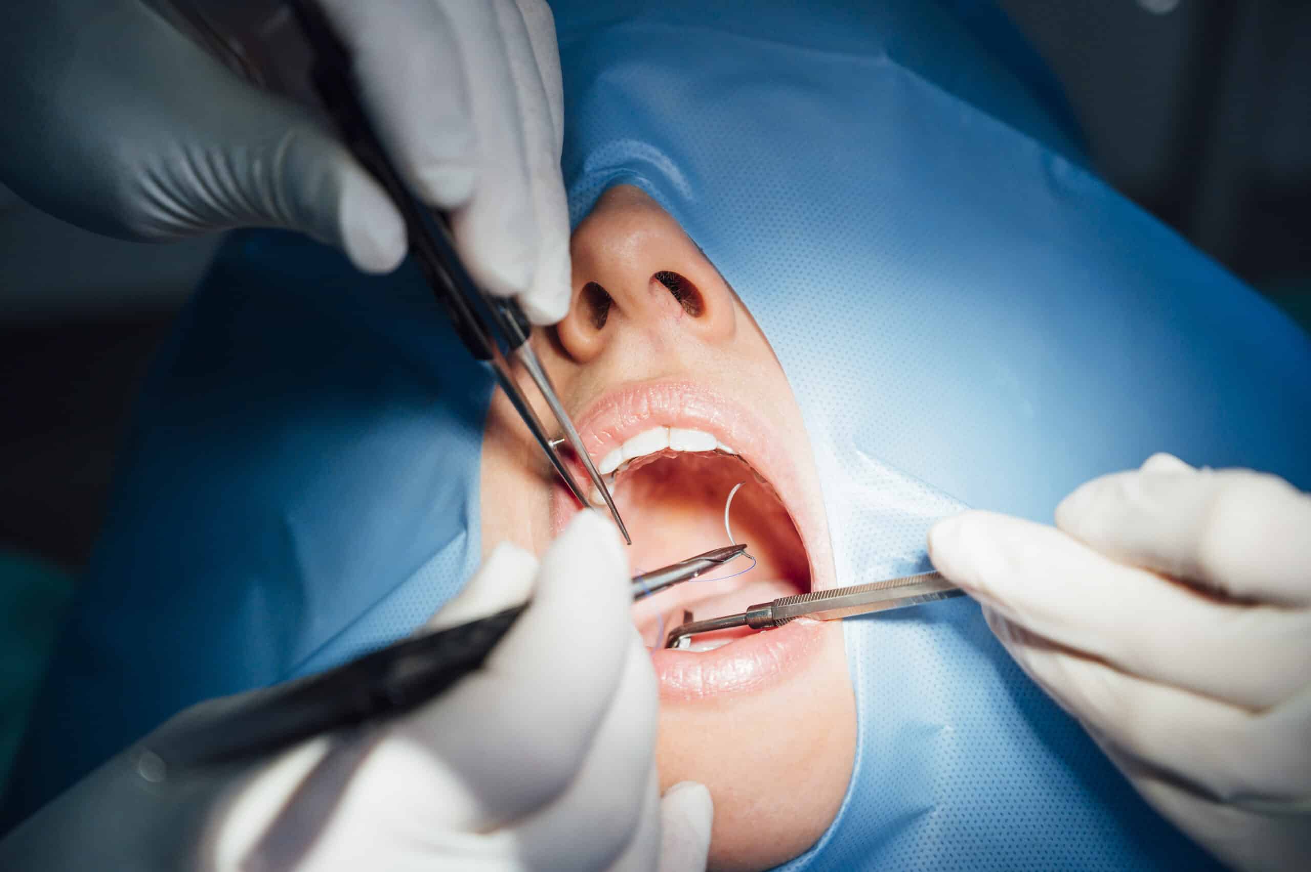 How Long Can You Leave a Cavity Untreated?