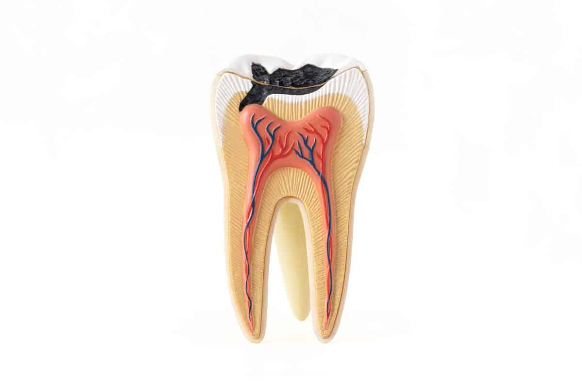 Tooth Abscess