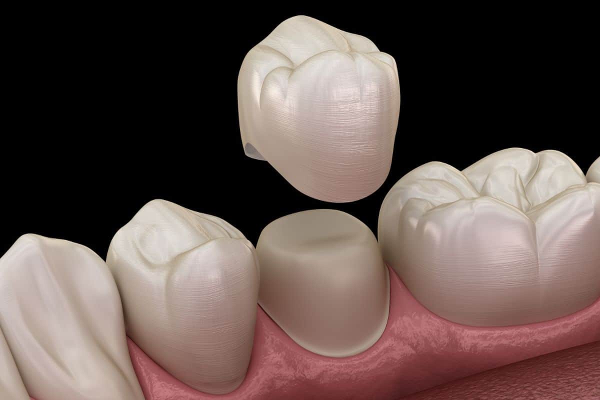 dental crown on front tooth