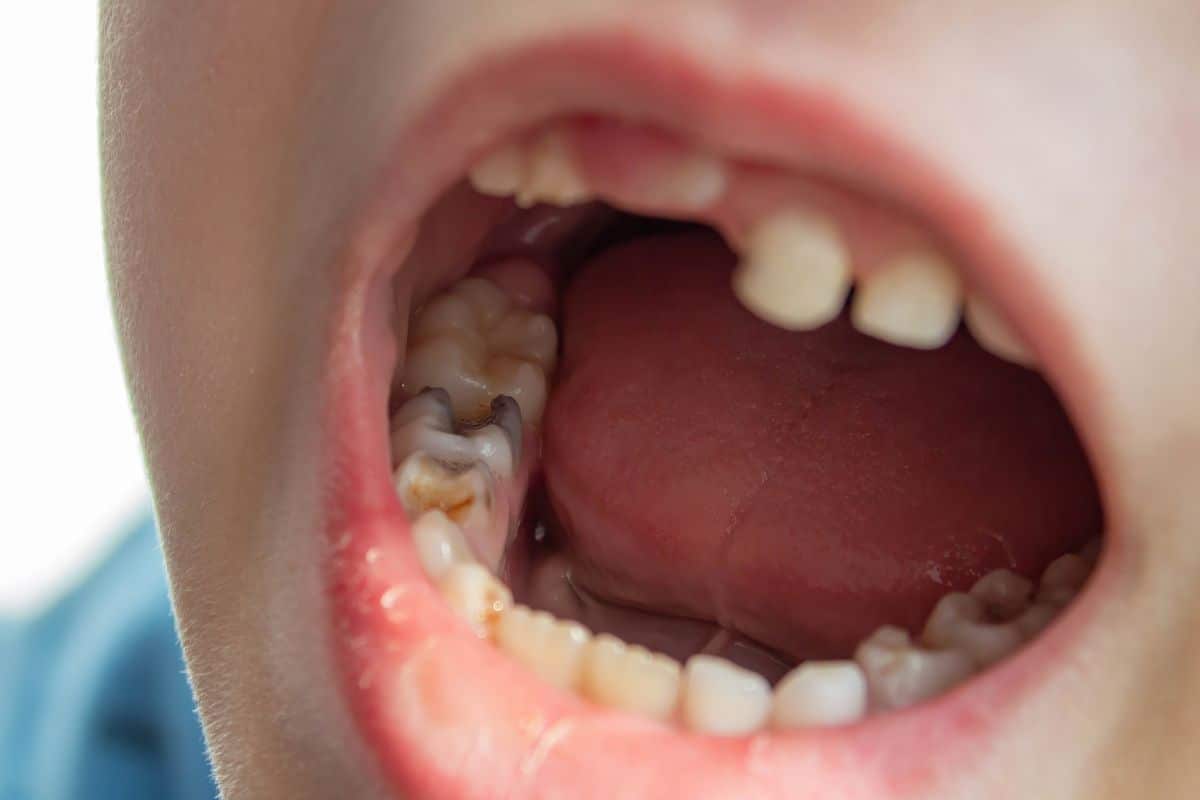Signs Your Tooth Infection Affects Your Body