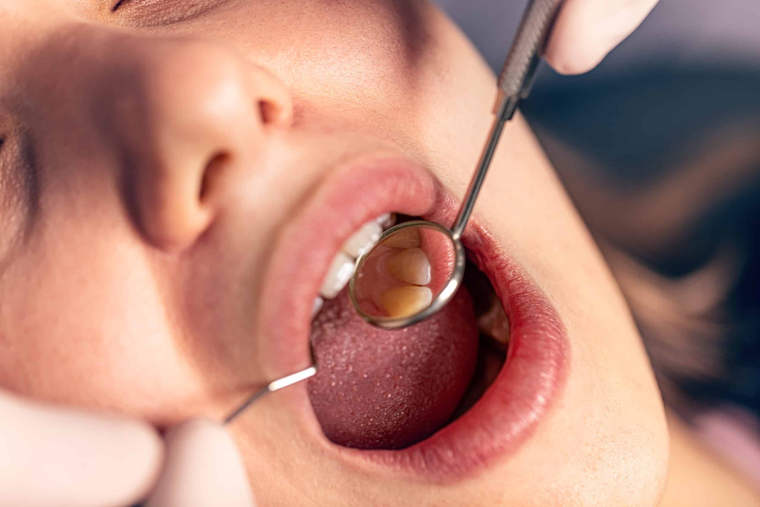 What Causes Gumline Cavities and How to Prevent Them?