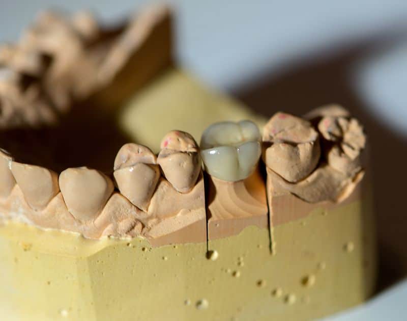 Why Does My Tooth Hurt When Using a Dental Crown?