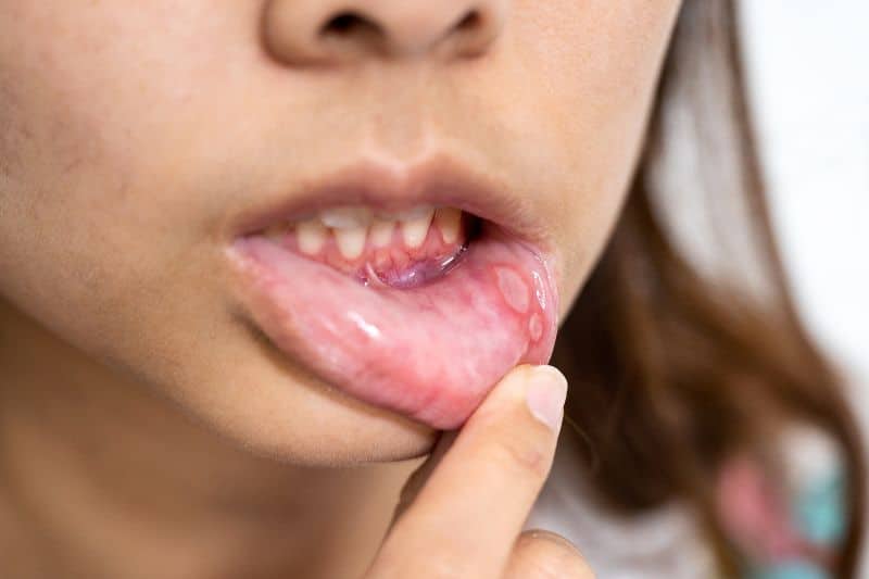 Foods & Drinks to Avoid If You Have Painful Mouth Ulcers