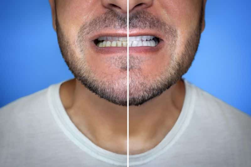 Does Teeth Whitening Work on All Types of Stains? Here’s What You Should Know
