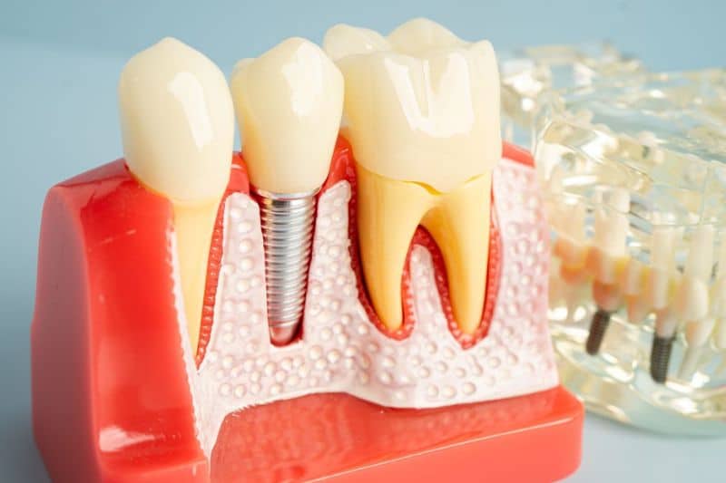 Exploring the Connection Between Dental Implants and Long-Term Oral Health