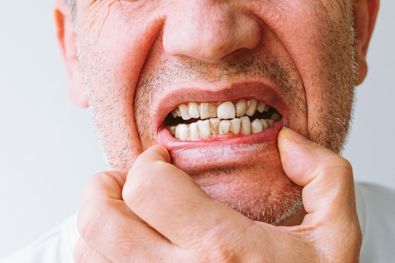 What Causes Black Teeth in Adults? A Simple Guide to Understanding the Signs