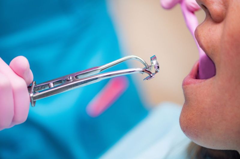 How Many Teeth Can Be Extracted At One Sitting?