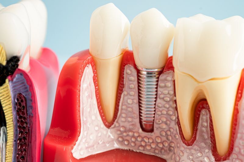 Do You Always Need a Bone Graft Before Dental Implants?